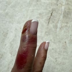 Princeton Nails - Infected finger today