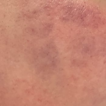 Allure Med Spa - More bruising - Medical Spas Near Me - Corpus Christi, Texas Allure Med Spa - More bruising - Medical Spas Near Me - Corpus Christi, Texas