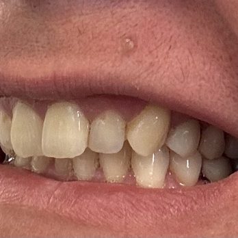 Sunset Dental Arts - New crowns - General Dentistry Near Me - Orange, California Sunset Dental Arts - New crowns - General Dentistry Near Me - Orange, California