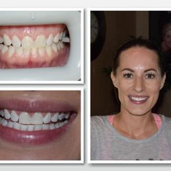 Whiten Up Today Laser Teeth Whitening