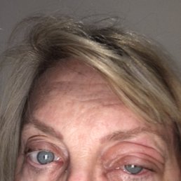 Infection after micro blading eyebrows. Week one. Has lasted four weeks. Infection after micro blading eyebrows. Week one. Has lasted four weeks.