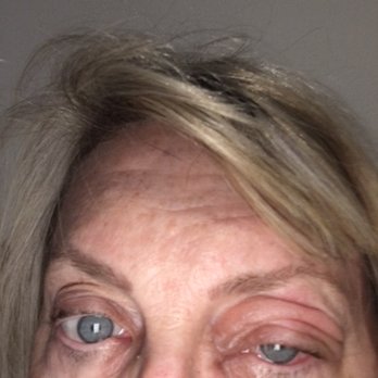 Forever Beautiful Spa - Infection after micro blading eyebrows. Week one. Has lasted four weeks. - Skin Care Near Me - Santa Barbara, California Forever Beautiful Spa - Infection after micro blading eyebrows. Week one. Has lasted four weeks. - Skin Care Near Me - Santa Barbara, California