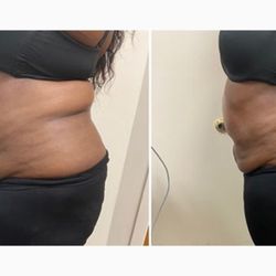 Cosmetic body cavitation treatments can effectively help you get rid of stubborn fat through specialized treatments that are non-surgical.