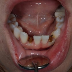 Elite Oral & Facial Surgery of Summerwood - Implant abutments placed
