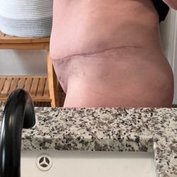 Bruce Byrne, MD - These photos are all 1 year post op!! Total abdominoplasty and liposuction