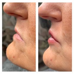 Lake Tapps Beauty Bar & Wellness - Lip enhancement