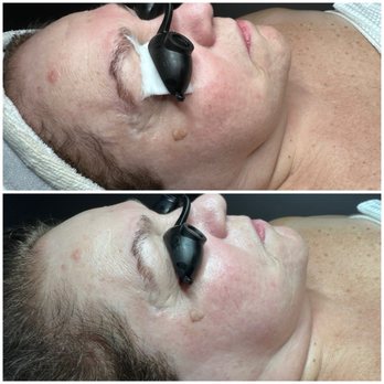 SkinSpirit - Del Mar - Before and after - Skin Care Near Me - Del Mar, California SkinSpirit - Del Mar - Before and after - Skin Care Near Me - Del Mar, California