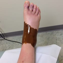Dancing Crane Center of Chinese Medicine - Treating a sprained ankle.