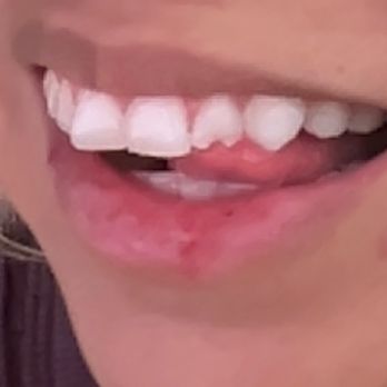 Krystal Smiles Dental - Chipped tooth - General Dentistry Near Me - Costa Mesa, California