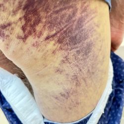 Hilltop House Assisted Living - These are photos where they said he fell on top of somebody and they never explained to me, even after repeatedly asked them what happened t