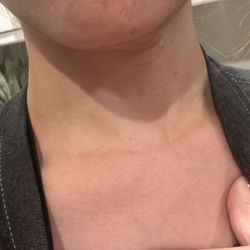 Minou P Tran, MD FACE - Thyroid scar