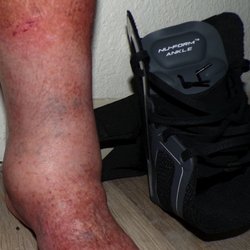 Hanger Prosthetics & Orthotics - My ankle next to the unusable brace they foisted off on me!! The receptionist said "If it doesn't fit you can throw it away." when I called.