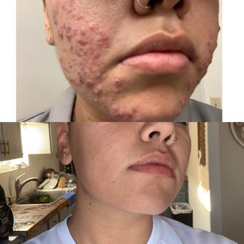Daisy MD Care - Before and After - Skin Care Near Me - Downey, California