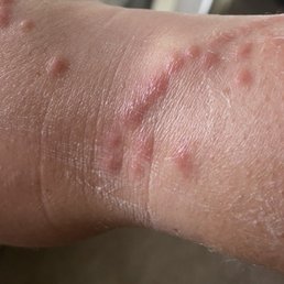 Bed bug bites from the resort Bed bug bites from the resort