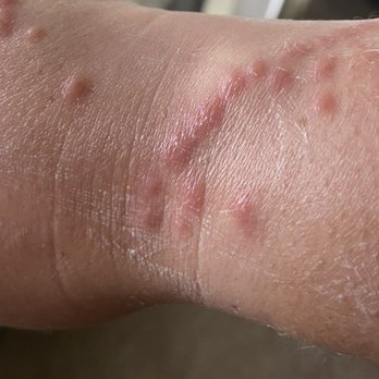 Sun Outdoors Rehoboth Bay - Bed bug bites from the resort - Campgrounds Near Me - Millsboro, Delaware Sun Outdoors Rehoboth Bay - Bed bug bites from the resort - Campgrounds Near Me - Millsboro, Delaware