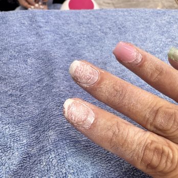 Vina Nails and Spa - Damaged nail from removal - Nail Salons Near Me - Irvine, California Vina Nails and Spa - Damaged nail from removal - Nail Salons Near Me - Irvine, California