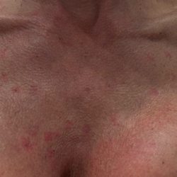Free & Clear Skin - Right after the pico laser targeting pigmentation on my chest!