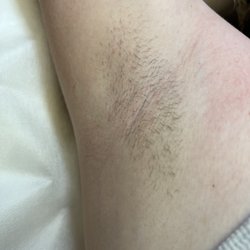 Cr Electrolysis & Laser Hair Removal - Before laser treatment