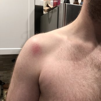 Glow Day Spa - Bruised arm after being "massaged" with elbows - Skin Care Near Me - Orange, California