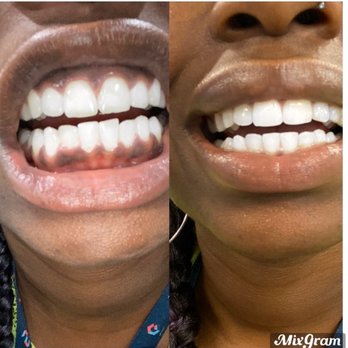 MINT dentistry | Mesquite - I received reshaping if my bottom 2 teeth, and a filling for a chipped tooth at the top. Amazing experience from Dr. Simpton. - General Dentistry Near Me - Mesquite, Texas MINT dentistry | Mesquite - I received reshaping if my bottom 2 teeth, and a filling for a chipped tooth at the top. Amazing experience from Dr. Simpton. - General Dentistry Near Me - Mesquite, Texas