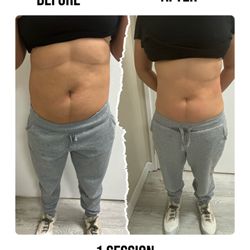 Mi Casa Day Spa - Before and after body Sculping one session
562-587-8733