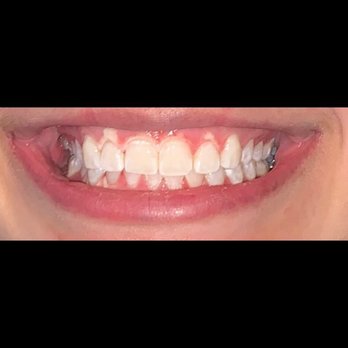 Crazy Love Studios - After one hour - Teeth Whitening Near Me - New York, New York