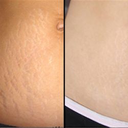 PermanentMakeup4U Clinic - Stretch Marks Improvement after only 1 treatment with Fibroblast Plasma