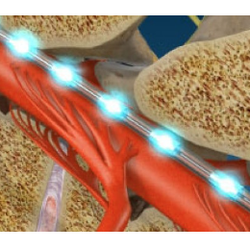 Advanced Pain Medical Group - Santa Clarita - Spinal Cord Stimulator Implant - This procedure uses electrical impulses to prevent pain signals from reaching the brain.