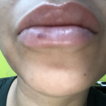 Beiamed Brows & Lashes - This is two weeks after fillers. - Skin Care Near Me - Miami, Florida Beiamed Brows & Lashes - This is two weeks after fillers. - Skin Care Near Me - Miami, Florida