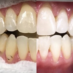 Sunriver Dental Care - Zoom whitening!!!!!