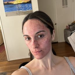 After procedure After procedure