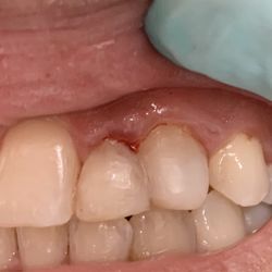 Steven A Berklacy, DDS - Composite bonding: after