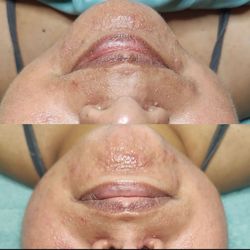 The Skin Sanctuary - Liquid Dream facial- H20/oxygen infusion