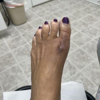 Atlantic Foot Specialists - Almost 3 weeks after surgery - Sports Medicine Near Me - Southport, North Carolina Atlantic Foot Specialists - Almost 3 weeks after surgery - Sports Medicine Near Me - Southport, North Carolina