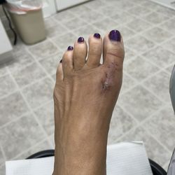 Atlantic Foot Specialists - Almost 3 weeks after surgery