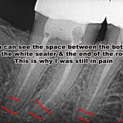 Burbank Family Dental - This is Dr Alex's bad root canal. There is a gap of space between the sealant and the bottom of the roots.