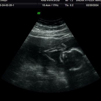 Sneak A Peek Imaging - 19 week Ultrasound - Diagnostic Imaging Near Me - Houston, Texas Sneak A Peek Imaging - 19 week Ultrasound - Diagnostic Imaging Near Me - Houston, Texas