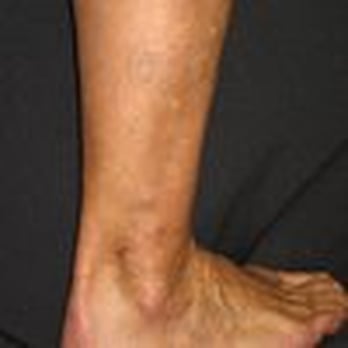 Schulman Vein and Laser Center - varicose veins after treatment - Medical Spas Near Me - Commack, New York Schulman Vein and Laser Center - varicose veins after treatment - Medical Spas Near Me - Commack, New York