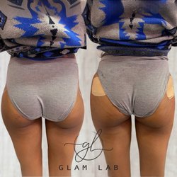 Glam Lab - Sculptra booty