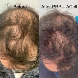 Before and after PRP with ACELL. Combined with topical finasteride to get max results.