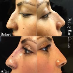 Beauty Bar Medical Clinic - Before & After of a nose correction done by Marco with Stylage
