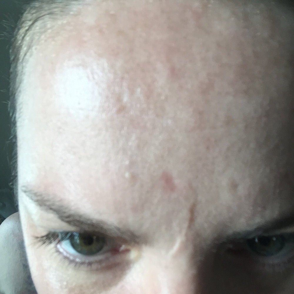 True Beauty Wellness Spa - Permanent Scarring! Acid burns -do not go to True Beauty! RUN - Skin Care Near Me - Long Beach, California True Beauty Wellness Spa - Permanent Scarring! Acid burns -do not go to True Beauty! RUN - Skin Care Near Me - Long Beach, California