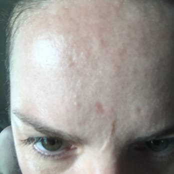 True Beauty Wellness Spa - Permanent Scarring! Acid burns -do not go to True Beauty! RUN - Skin Care Near Me - Long Beach, California True Beauty Wellness Spa - Permanent Scarring! Acid burns -do not go to True Beauty! RUN - Skin Care Near Me - Long Beach, California