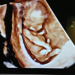 Angel Vision 3D/4D Ultrasound