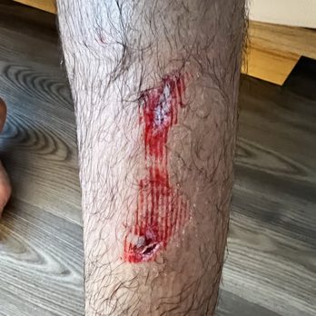 AC Hotel Miami Beach - Deep cut to leg caused by pool area - Hotels Near Me - Miami Beach, Florida AC Hotel Miami Beach - Deep cut to leg caused by pool area - Hotels Near Me - Miami Beach, Florida