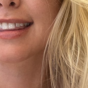 Petit Medispa - After - Skin Care Near Me - Fullerton, California