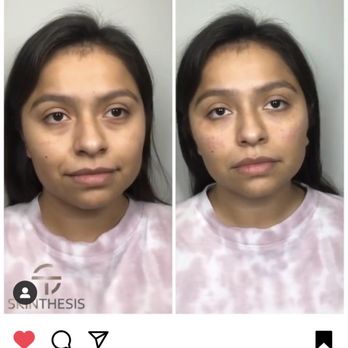 Skin Thesis - 1 mL Restylane Refyne & 2 x 1 mL Juvederm Voluma - Medical Spas Near Me - West Hollywood, California