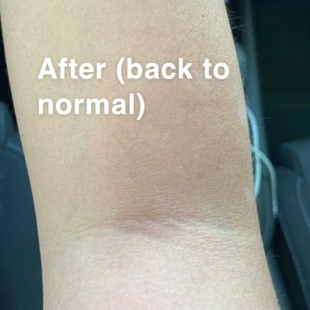 BHSkin Dermatology - After steroid cream treatment for pityriasis rosacea on arm - Dermatologists Near Me - Glendale, California
