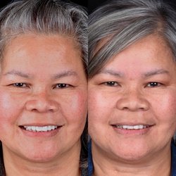 Newhall Dental Arts - Before and after smile rejuvenation