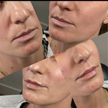 Jolene Aesthetics - As we age, it's not just about volume loss -- the entire structure of the lips changes - Medical Spas Near Me - Carlsbad, California Jolene Aesthetics - As we age, it's not just about volume loss -- the entire structure of the lips changes - Medical Spas Near Me - Carlsbad, California